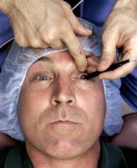 Cirurgia-corretora-de-miopia-3